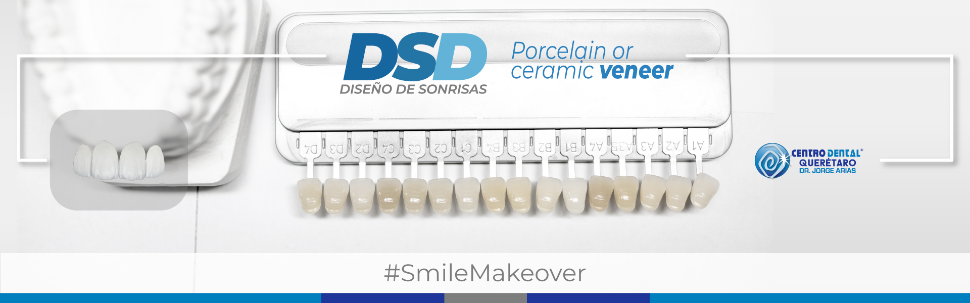 Carillas Dentales de Porcelana